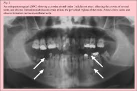 When brushing your teeth, make sure to reach as far back in the mouth as possible to clean around the wisdom tooth. Management Of Acute Dental Pain A Practical Approach For Primary Health Care Providers Australian Prescriber