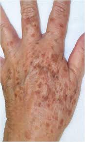 Brown Age Spots On Hands See This Age Spot Information And How People Have Resolved Their Problems Brown Spots On Skin Brown Spots On Face Brown Spots On Hands