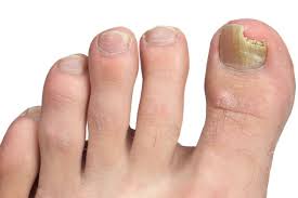 fungal nail infection nhs