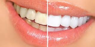 Mit fachwissen, innovativen behandlungskonzepten und individueller betreuung möchten wir ihnen zu einem strahlenden und gesunden lächeln verhelfen! Bleaching Zahnarzt Marburg