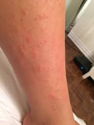 In most instances, you shouldn't. 1 Day Post Laser Hair Removal And Experience Very Itchy Red Bumps On Legs Is This Normal And What S The Cause Photos