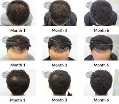 In this stage of male pattern baldness, the norwood scale indicates that you are sure to lose a lot of hair. Hair Growth Success Story One Of The Best Decisions I Have Made
