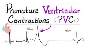 Image result for Extrasystole