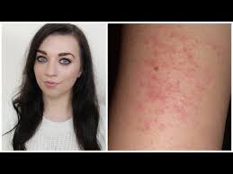 How To Treat Hide Keratosis Pilaris Makeupbysaz Keratosis Pilaris Keratosis Pilaris On Face Treat Keratosis Pilaris