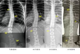 Treatment may involve exercises, surgery, physical the prognosis for an individual with scoliosis ranges from mainly good to fair, depending on how early the problem is diagnosed and treated. Correct Scoliosis Without Surgery Scoliosis Correction Reduce Scoliosis