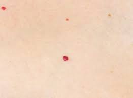 Caution must be employed when using electrocautery as a. Cherry Angiomas Red Spots Laser Melbourne