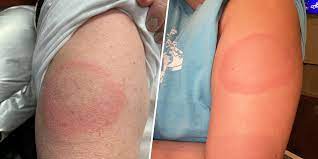 The side effects tend to be benign, with fatigue, injection site pain and headaches. Covid 19 Vaccine Delayed Skin Reaction Redness Rash A Week After Shot