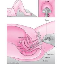 However, regular pap smears and hpv testing of the cervix can allow your doctor to find precancerous cells or early. What Happens During A Smear Test Jo S Cervical Cancer Trust