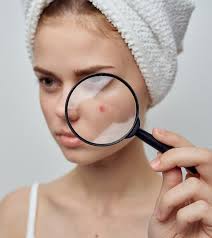 While there's no single cause for acne, experts agree that lacking certain nutrients may play a role. How To Use Vitamin E For Acne