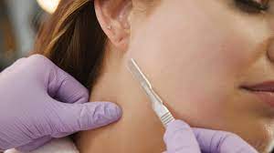 The result is smooth skin! What Is Dermaplaning And Why Should You Try It Today