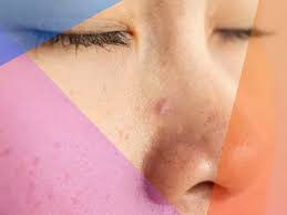 | meaning, pronunciation, translations and examples. How To Get Rid Of And Prevent A Pimple Inside Your Nose