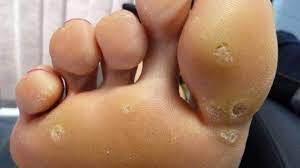 Biasanya untuk bisa membuat sebuah link zoom, kamu harus menjadi host dari meeting yang akan. 7 Cara Nak Hapuskan Ketuat Degil Di Kaki Dengan Pantas Try Sendiri Mesti Berkesan Kartel Dakwah