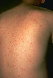 Image result for Secondary Syphilis