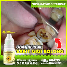Gusi bengkak adalah kondisi di mana gusi membesar secara abnormal dan terasa menonjol. Ubat Sakit Gigi Berlubang Farmasi