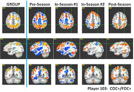 Result of numerous impacts over extended periods. Football Findings Suggest Concussions Caused By Series Of Hits