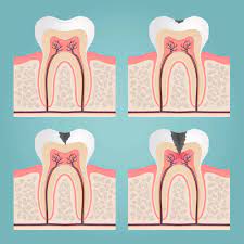 Most dying tooth can be saved by root canal treatment. How To Identify And Treat A Dead Tooth Advice From A Dentist Electric Teeth