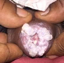Sexually transmitted diseases aren't rare—half of us will have one at some point in our lives. How To Tell That If You Have An Std Tibot