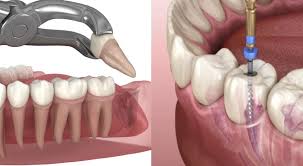 Image result for Tooth Extraction