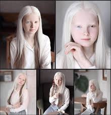 A girl with albinism and heterochromia : pics