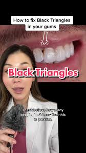 All about Black Triangles! Why they happen and how we can treatment them :)  #dentist #blacktriangles #bioclear