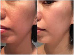 A Review of Snow Caps Glutathione