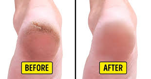 But dead skin from the foot is visibly black and painful. 10 Home Remedies To Remove Cracked Heels And Get Beautiful Feet