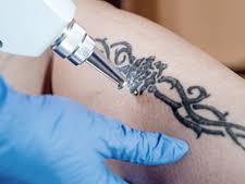 In other words, if temporary markers become wet, you could risk your radiation therapy being inaccurate. Bfs Tattoo Removal Removal Of Tattoos