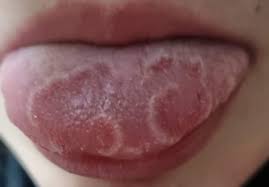 Image result for Puchýře na jazyku