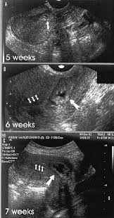 Maybe you would like to learn more about one of these? Ultrasound Follow Up At 5 6 And 7 Weeks Gestation At 5 And 6 Weeks Download Scientific Diagram