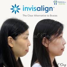 ✨ 3-Year Smile & Profile Transformation ✨ This lovely patient visited Dr.  Arial for an orthodontic consultation, concerned about her dental  protrusion. After a detailed assessment, she agreed to remove 4 teeth