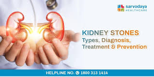 Kidney Stones Types Diagnosis Treatment Prevention
