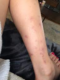 How to get rid of mosquito bites on babies skin? Help How To Get Rid Of Old Bug Bite Scars On My Legs I Ve Tried Mederma Bio Oil And Even Steroid Cream Nothing Has Helped Skincareaddicts