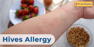 Image result for Hives