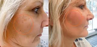 Jan 13, 2021 · gegen altersflecken und hautflecken gibt es gut wirksame hausmittel, die schon seit generationen bekannt sind. Pigmentflecken Entfernung Nach Nur Einer Behandlung Harz Aesthetik