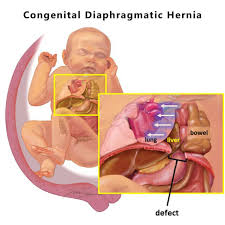 congenital diaphragmatic hernia cdh treatment johns