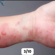 Image result for genital herpes