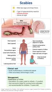 Image result for scabies human children