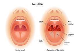 Next section of this article deals with measures to prevent tonsil stones from developing in the oral cavity. Pin On Au Naturale