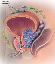 If cancer has reached these lymph nodes, it may have also spread to other lymph nodes, the bones, or other organs. Case Study New Statewide Referral Pathways And Prostate Cancer North Western Melbourne Primary Health Network