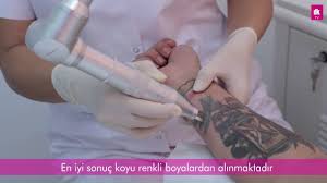 Dovme Silme Uygulamasi Antalya Dk Klinik Dovme Antalya