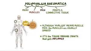 Image result for Polymyalgia Rheumatica