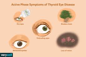 Mine swells in heat and loves the cold. Progression And Prognosis In Thyroid Eye Disease