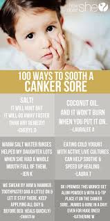 100 Ways To Soothe A Canker Sore Canker Sore Canker Sore Remedy Health Remedies