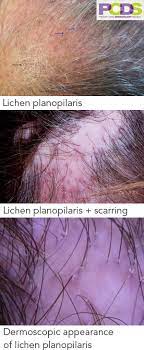 Over 21 million women and 35 million men in america suffer from hair loss. Can You Give Me More Information On Lichen Planopilaris