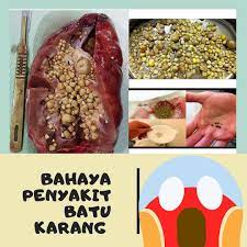 Penyakit batu karang (kidney stone) adalah masalah kesihatan yang lazim terjadi di kalangan lelaki. Hapus Batu Karang Dengan Mudah Posts Facebook