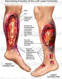 The most commonly affected areas are the limbs and perineum. How Does Necrotizing Fasciitis Known As Flesh Eating Disease Begin Quora