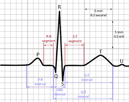 Basics Of Ecg Interpretation Of Waves And Intervals Epomedicine