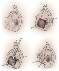 Image result for Bartholin's gland abscess