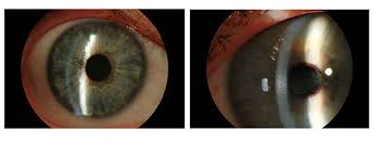 Image result for Cornea