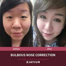 The best modern treatment available for a bulbous nose is rhinoplasty surgery. Can Someone Please Show Me What A Bulbous Nose Looks Like Plasticsurgery